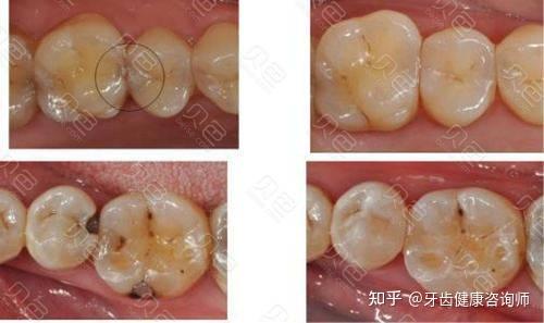 过来人补牙经历告诉你,补牙100和300元材料有什么区别? - 知乎