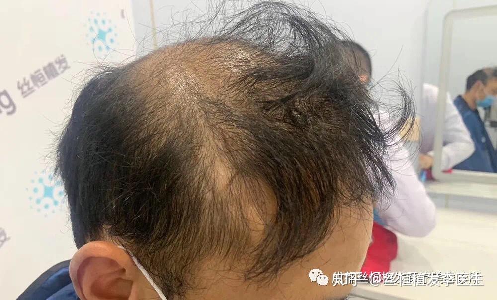 你必须了解的植发的几大危害