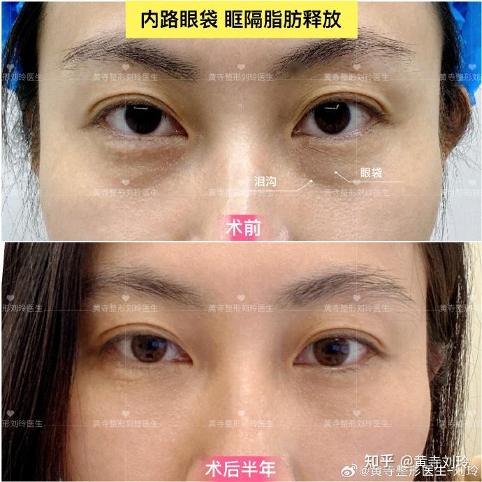 北京内路眼袋 眶隔脂肪释放，术后一个月 - 知乎