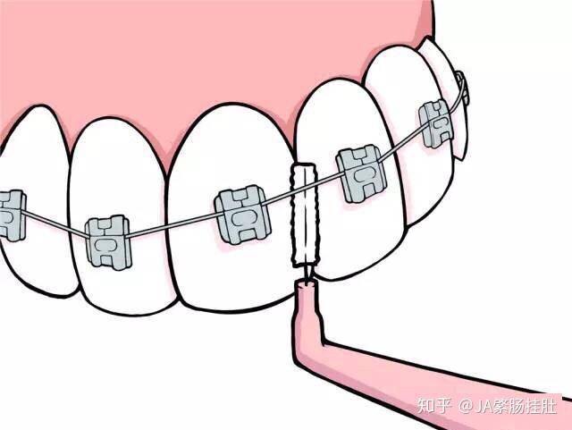 正畸期间如何正确地刷牙