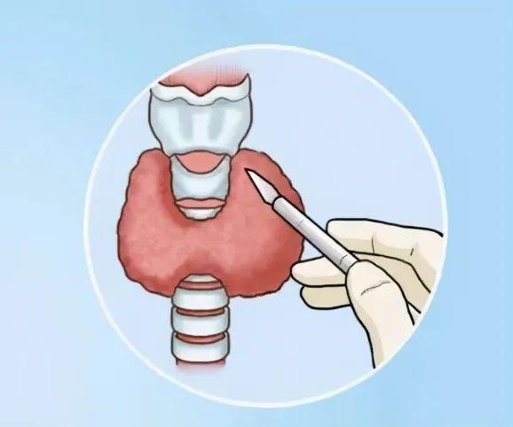 查出甲状腺癌,应该怎么办? - 知乎