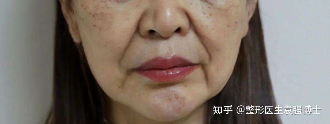 法令纹太深的这两大原因,医生给你详细解析 - 知乎