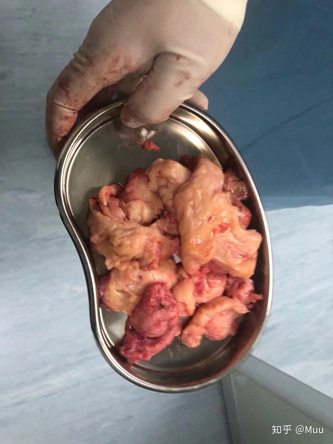 单孔腹腔镜子宫肌瘤剔除手术最大124cm病情五年多