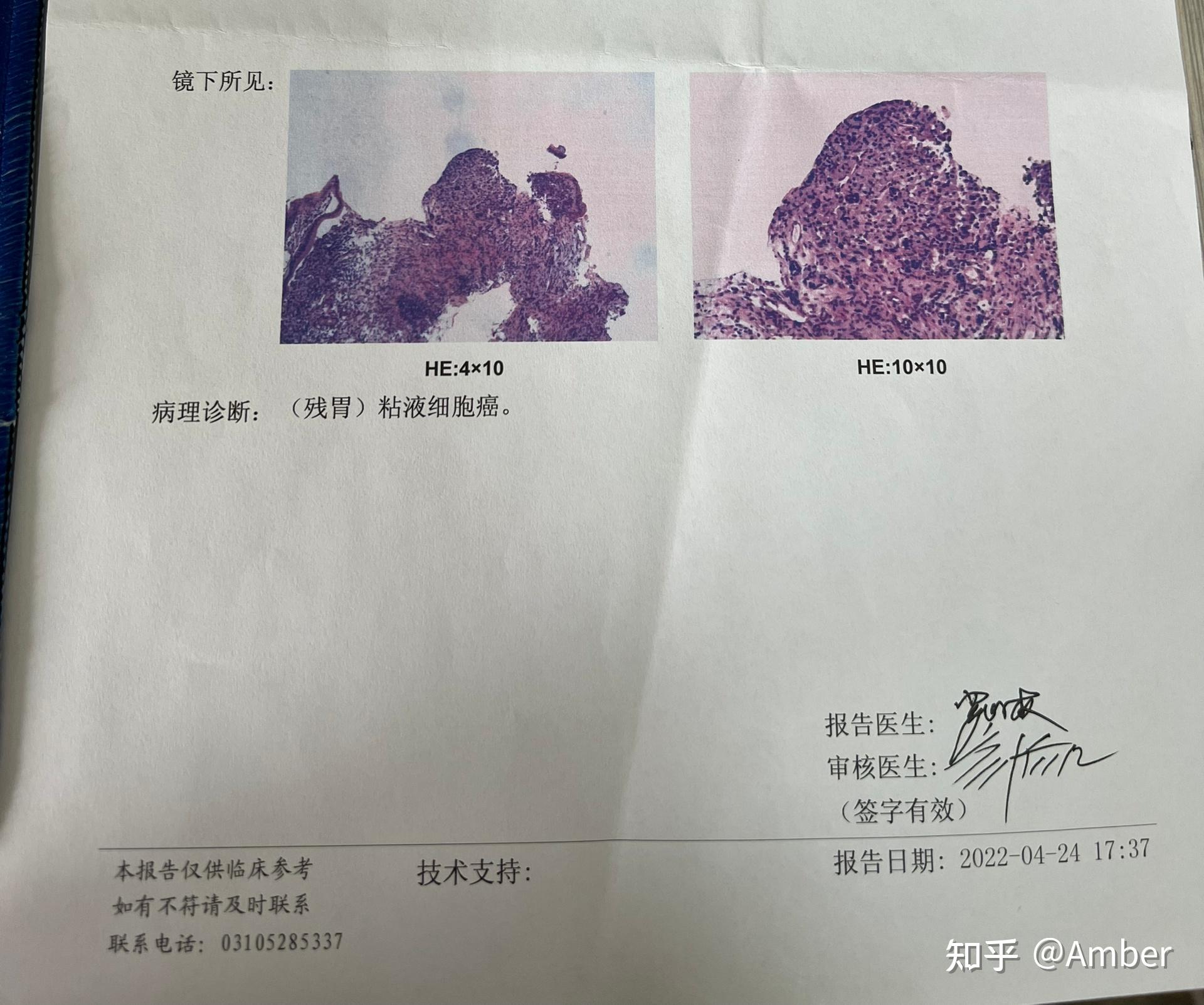 殘胃癌腹膜轉移合併腸梗阻記錄這段痛苦的日子