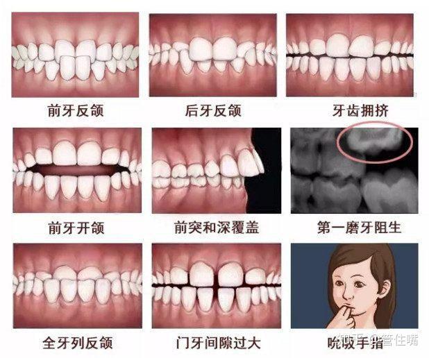 牙齿的近远中示意图图片