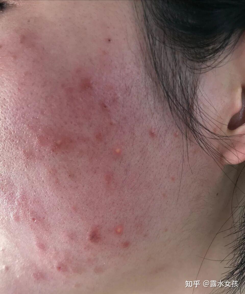 补水时痘痘会越来越多吗开口闭口型粉刺怎么办