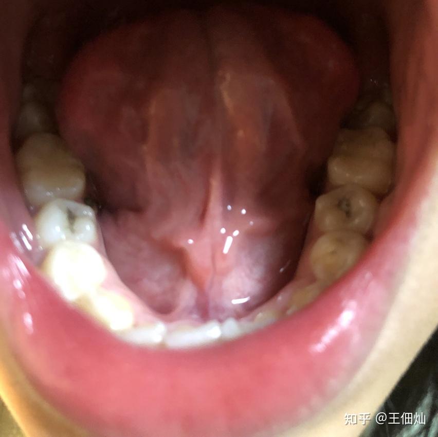 口内型舌下腺囊肿可以自愈,不用手术