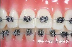 怎么选择适合自己的牙套 v2-d8434f3813bd49e80059a8d37631086a_b.jpg
