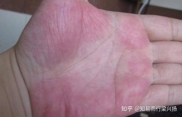 什么是血瘀掌?手掌发紫是健康告急,出现这些要注意! - 知乎