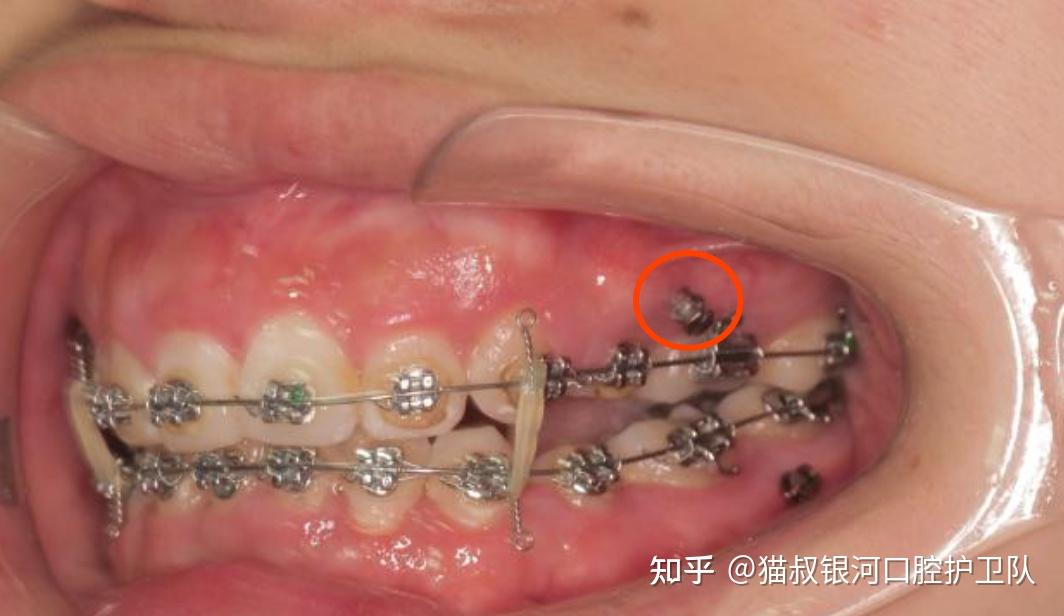 但如果遇到以下问题:如需要内收前牙, 需要前移后牙,需要压低前牙