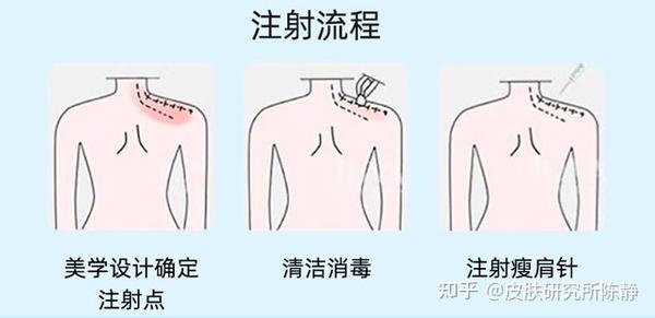 二,瘦肩针作用原理是什么?