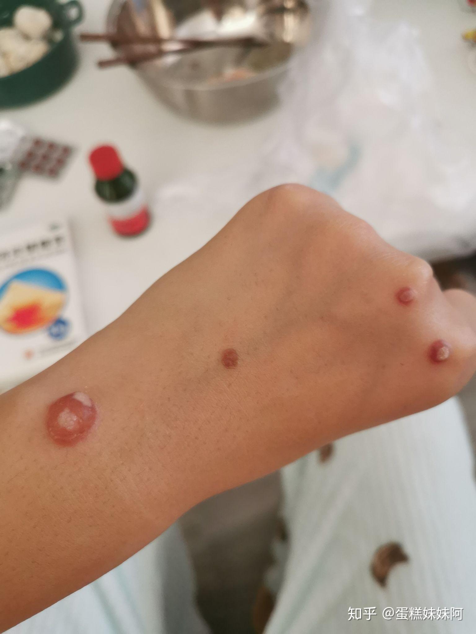 扁平疣记录我做冷冻的这段时间
