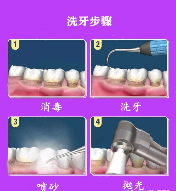 洗牙步骤 