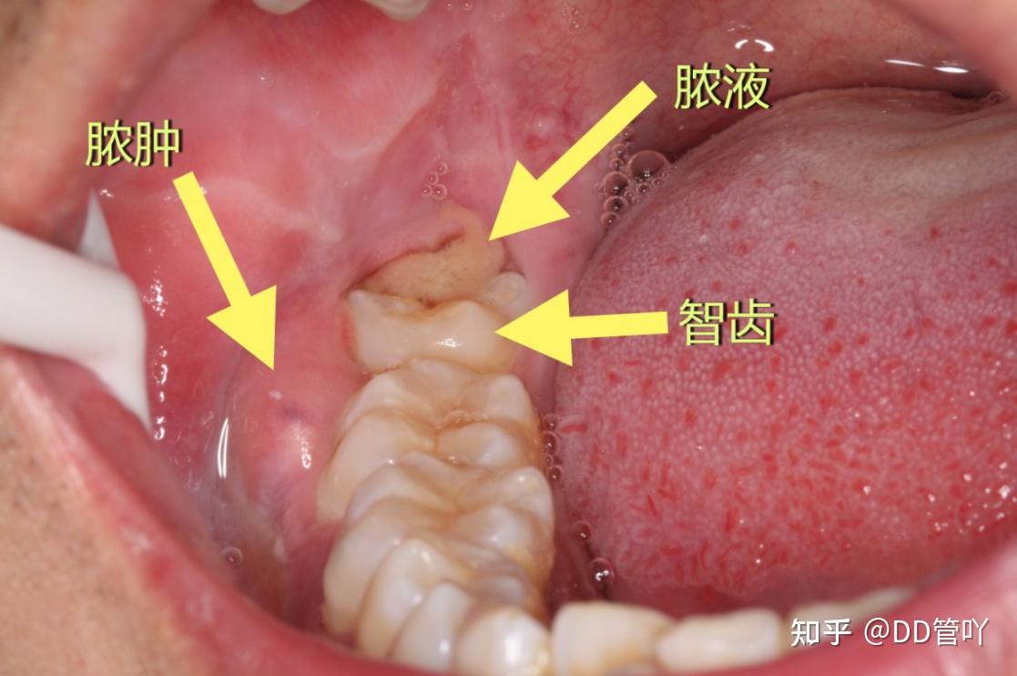 拔智齿太可怕了,可以不拔吗?这么科普的知识,拿来吧你