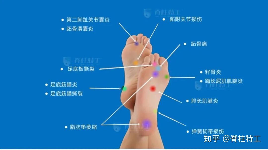 一张脚痛地图，教你自查55种疾病 知乎 