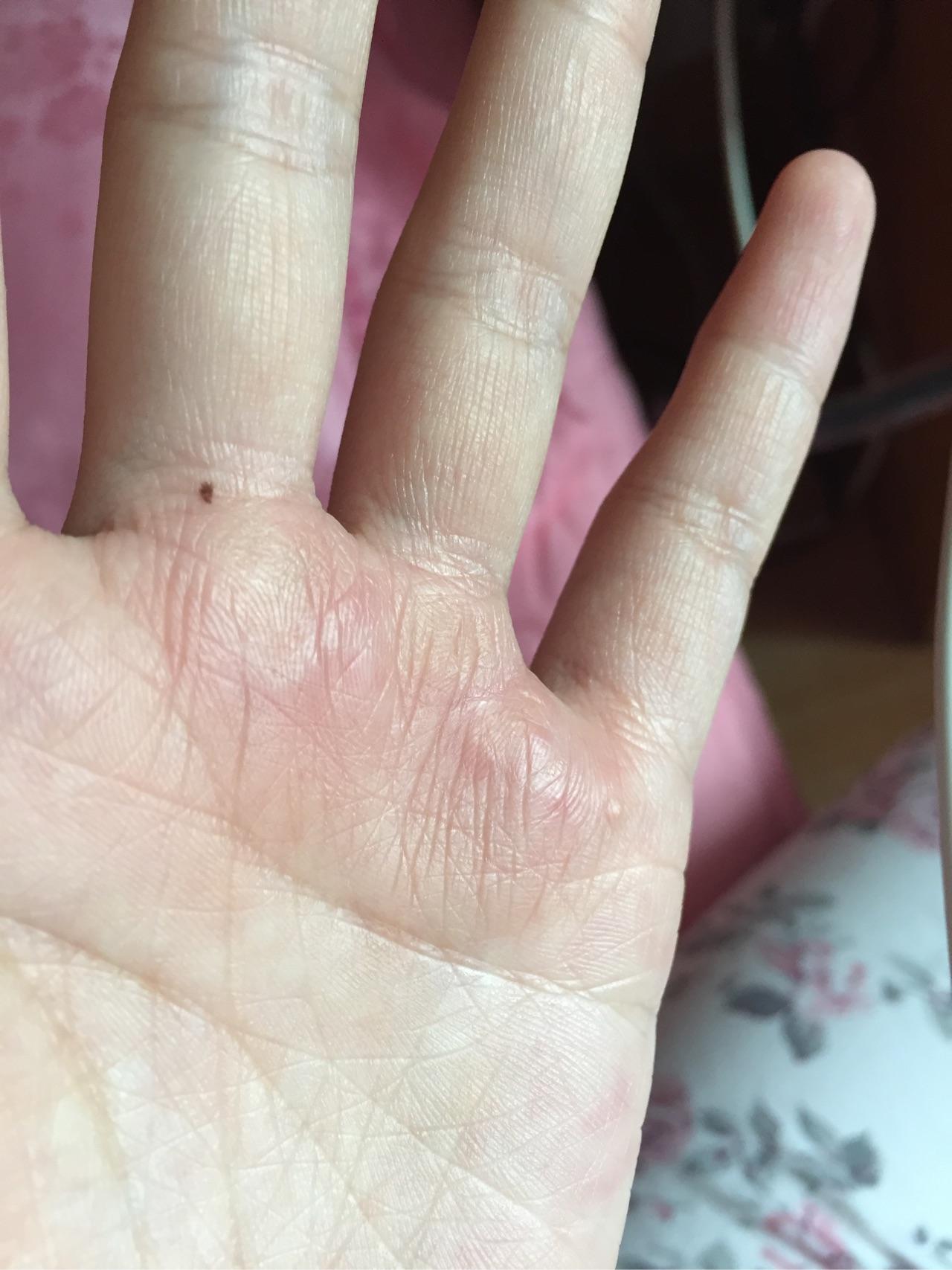 手指长水泡一直不好是湿疹还是手癣还是神马