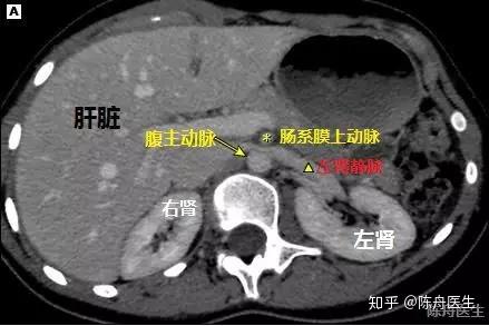 胡桃夹CT图片图片