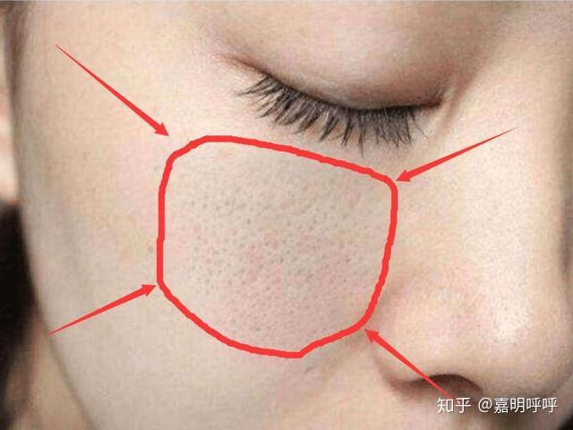 一分钟了解闭口黑头毛孔粗大怎么办变美从根源入手