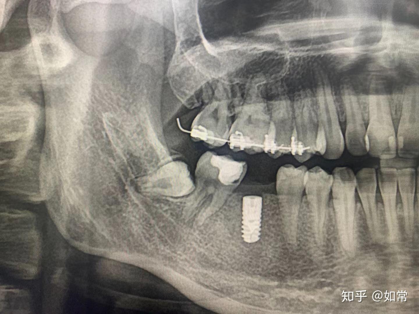 我的種牙日記包括拔智齒補牙嵌體種牙正畸已結束