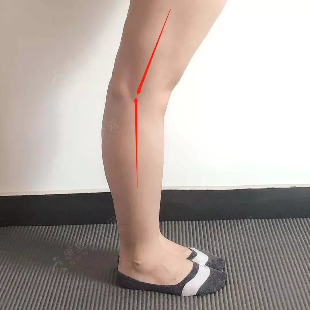 大腿前凸小腿后凸且腿不直是弯的小腿处有空隙怎么矫正？ - 知乎