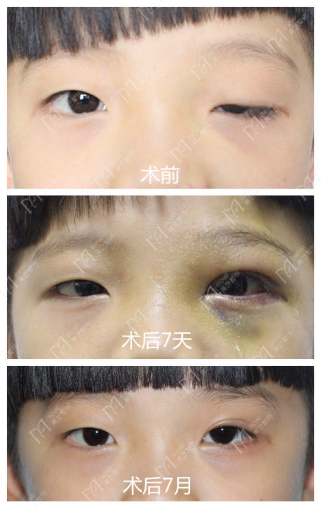 婴儿双眼皮几个月成型（宝宝眼睛会随年龄变大吗）-幼儿百科-魔术铺
