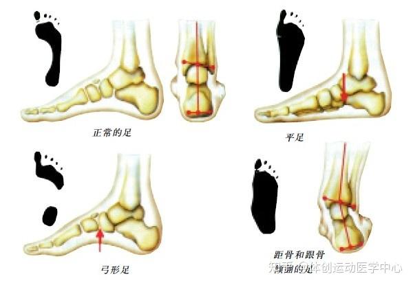 针对足底筋膜炎，别忘了“趾短屈肌”！