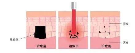 皮秒激光大百科,常见皮秒仪器如何选择? - 知乎