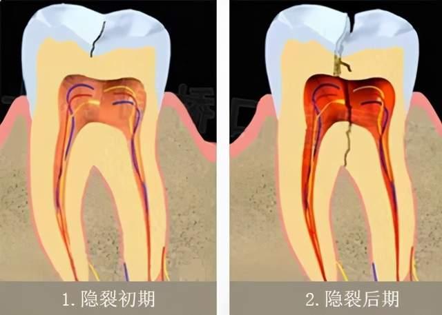 牙隐裂是什么?危害有多大?