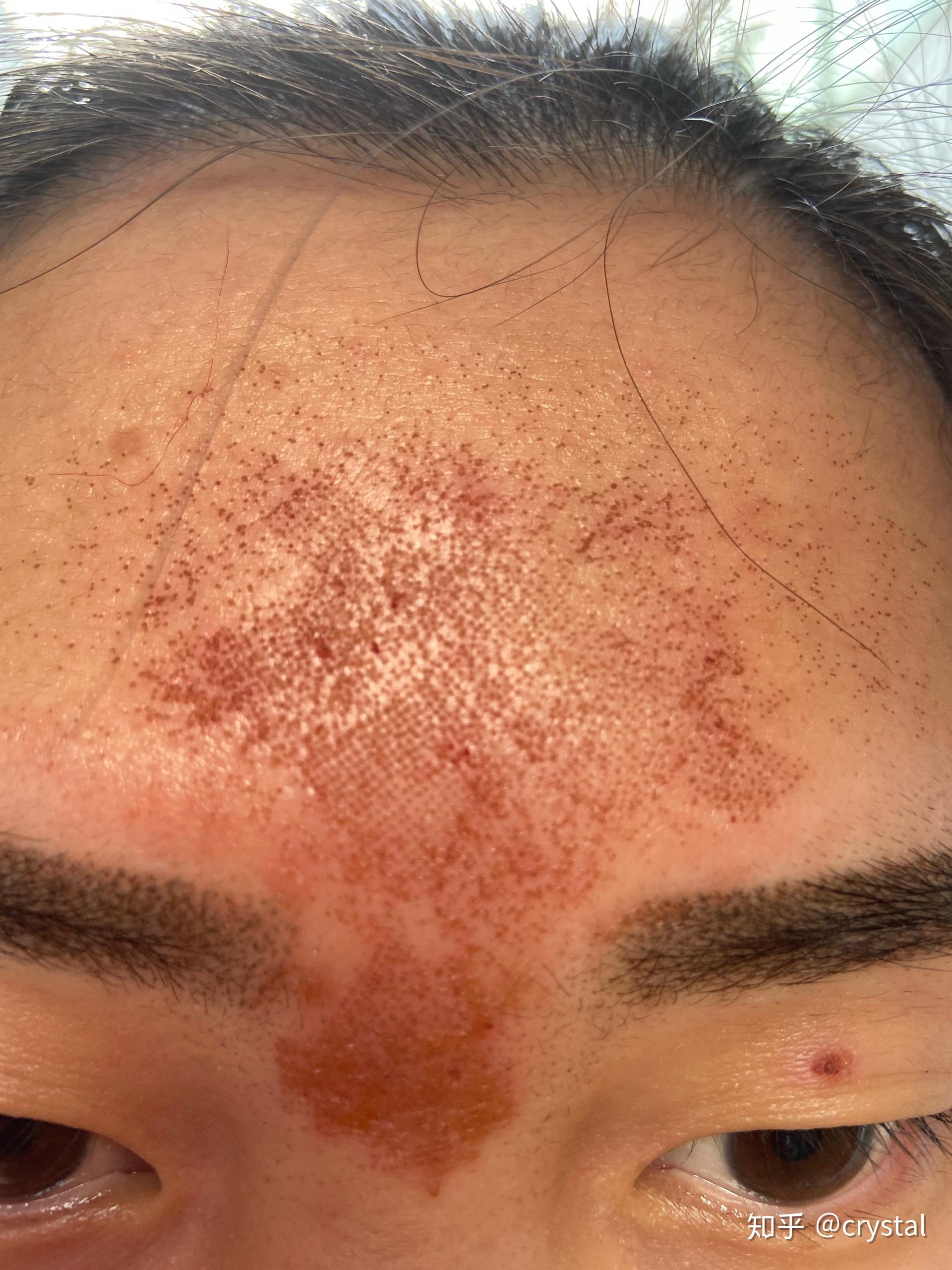 第一次点阵激光去痘坑