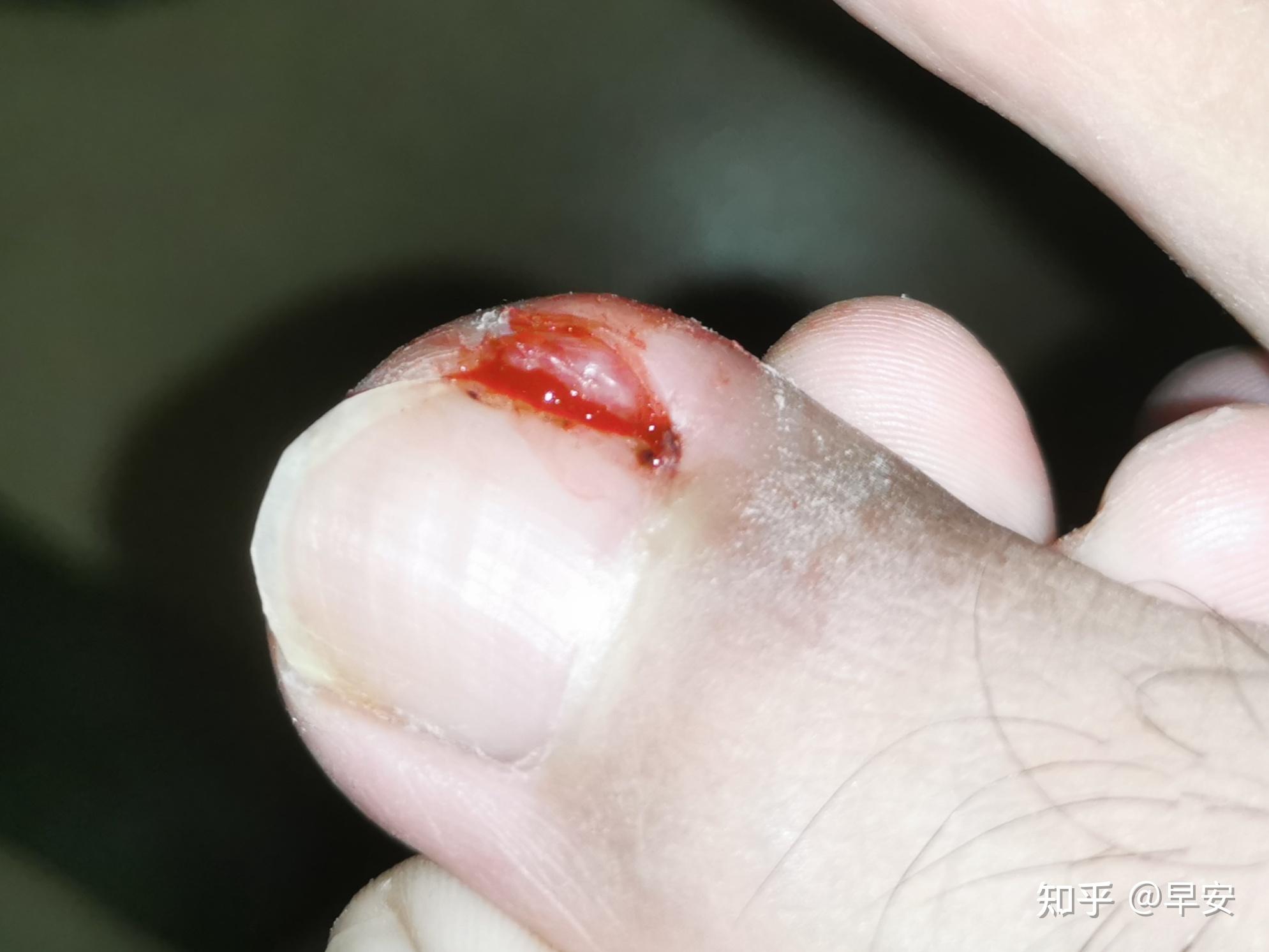 记录一次甲沟炎拔脚趾甲的过程