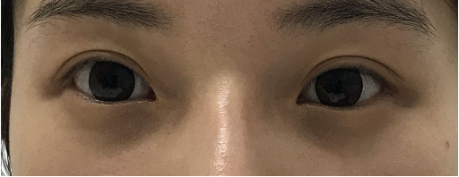 案例2: 内眦开大,下至,外眦开大术前案例2: 内眦开大,下至,外眦开大术