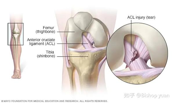 关于aclr 前交叉韧带重建术后 早期的一些见解 知乎