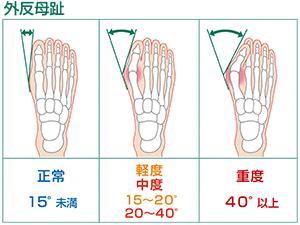 Youareyou拇指外翻鞋之自己如何测试拇指外翻 知乎