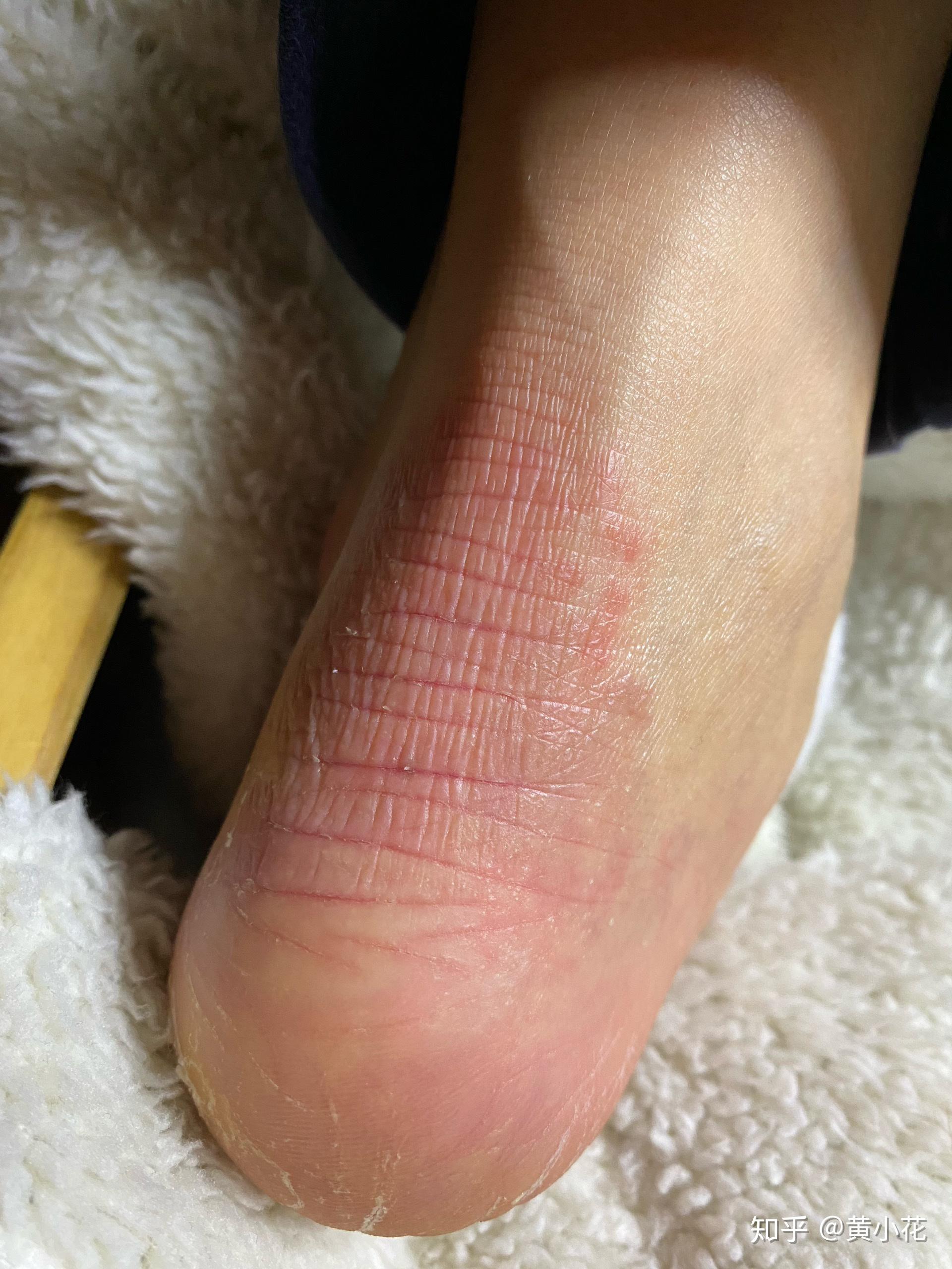 脚踝处长一片红点