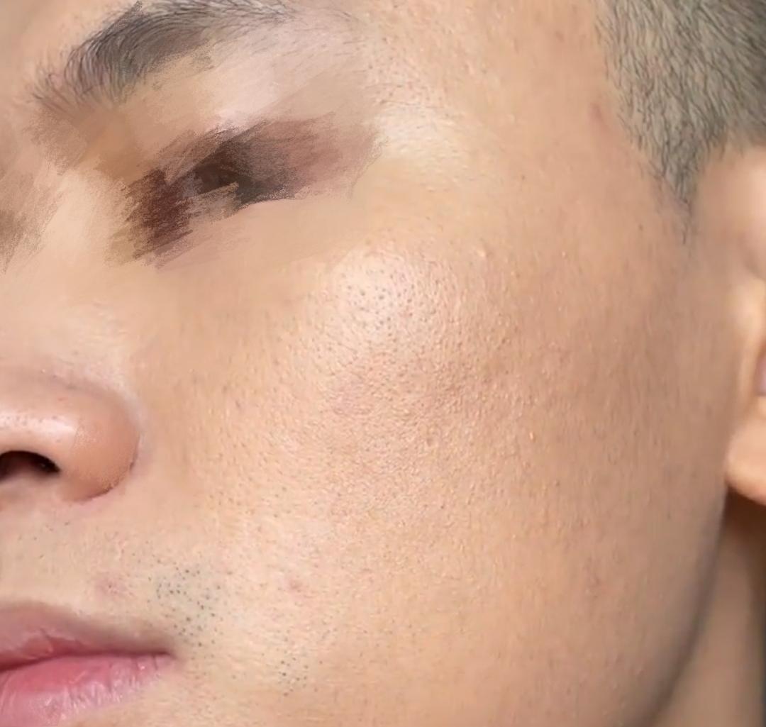 男生毛孔粗大黑头多出油长痘怎么办点这里三个月改变皮肤极高性价比超