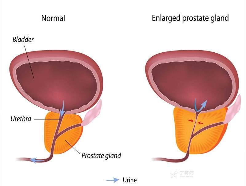 膀胱出口梗阻模型-【动物造模】