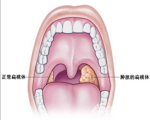 扁桃體炎中醫又叫乳蛾,是指因外邪侵襲,邪毒積聚喉核,或臟腑虧損,咽喉