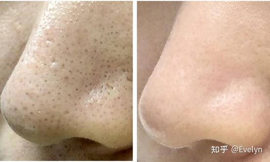康康这前后对比,黑头真的滚蛋了!