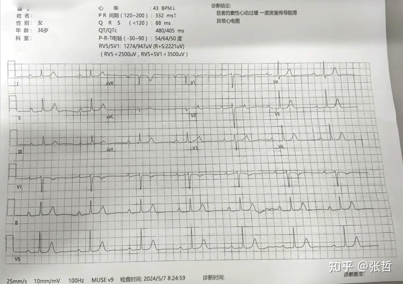 右束支完全性阻滞怎么治疗为什么在线