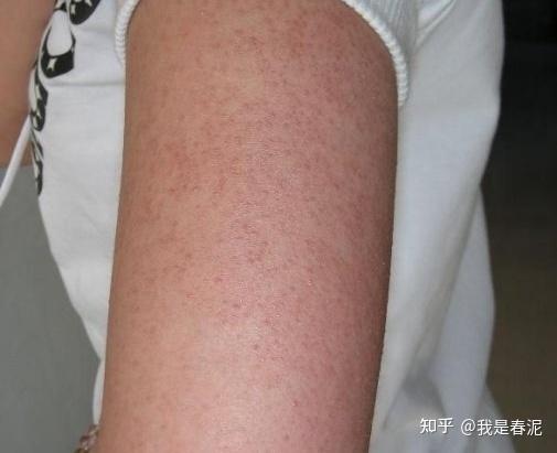 你们是怎样去鸡皮的