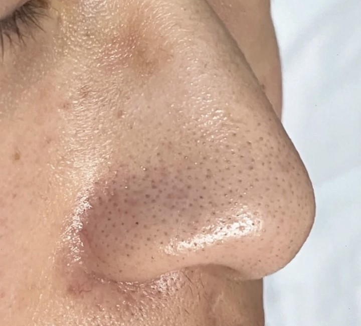 3.清理黑头角质,深层清洁