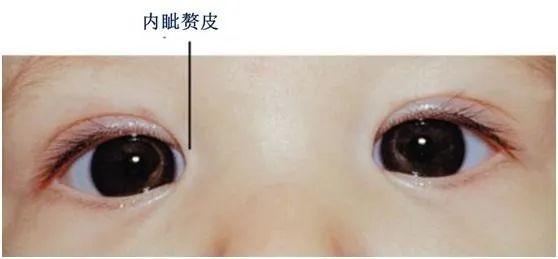 【眼健康小课堂】什么是内斜视?