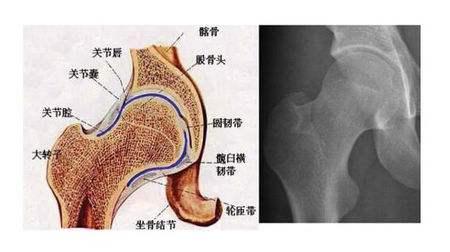 股骨头坏死出现和哪些因素有关