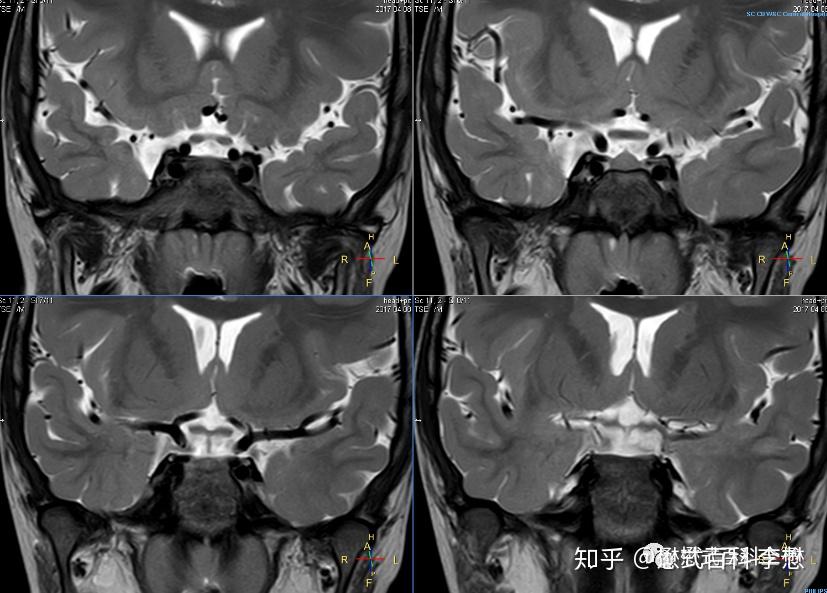 磁共振垂体扫描pituitary mr imaging(一)