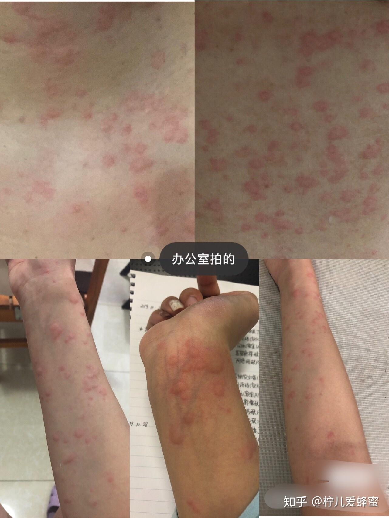 近一年的慢性荨麻疹终于痊愈了感动