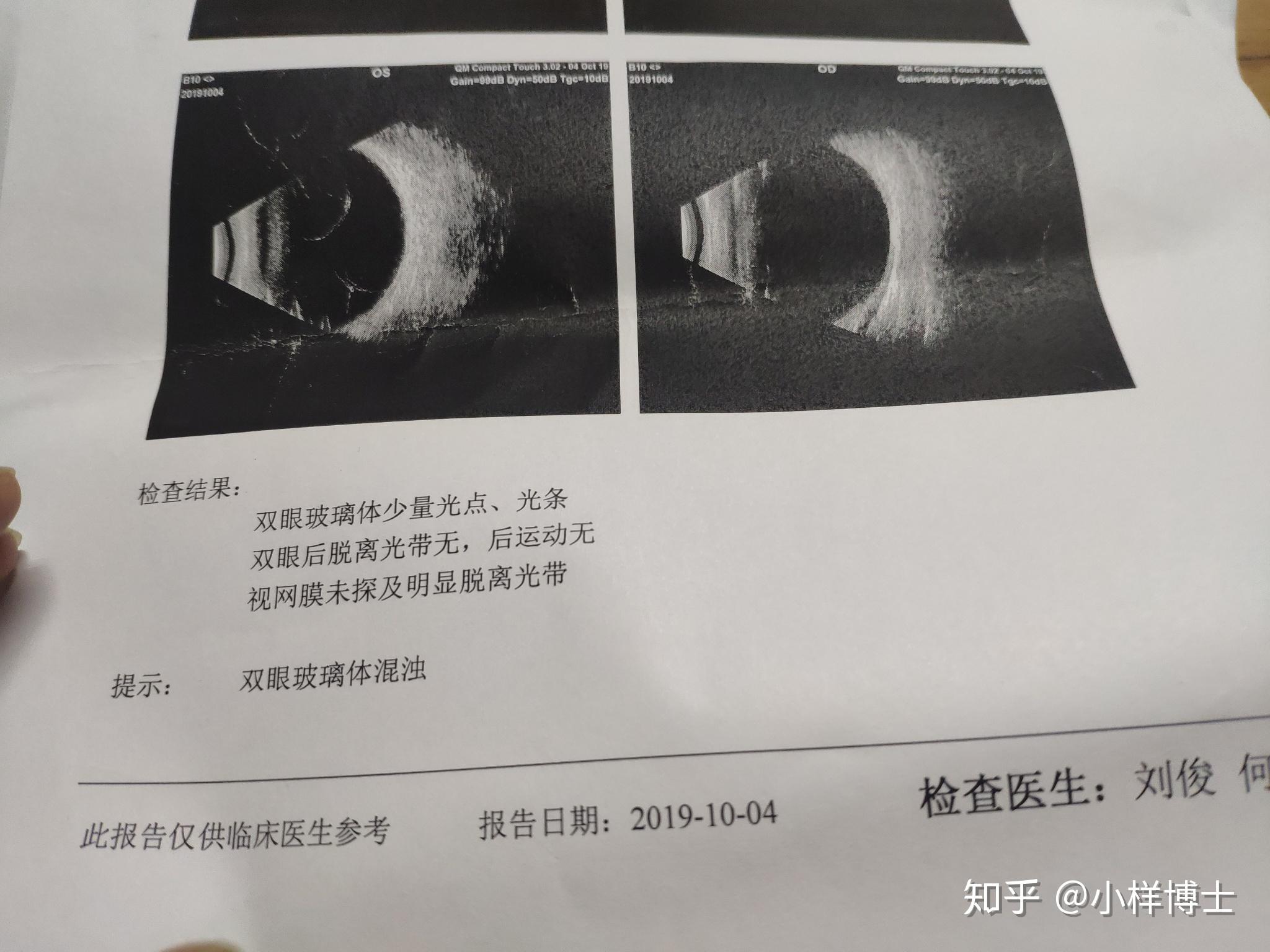 亲身试验飞蚊症变化的过程