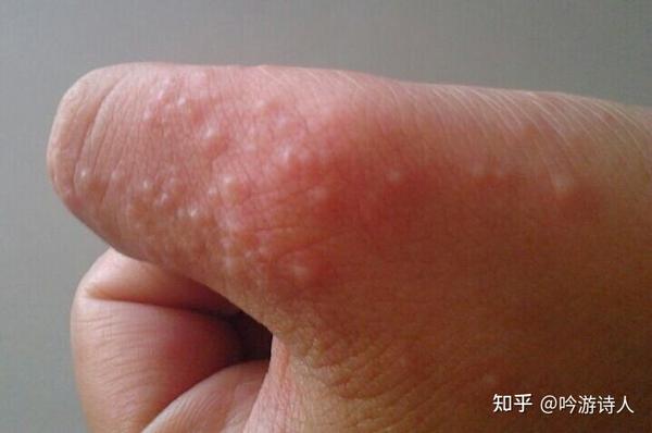 经过仔细打探,这基本上都是用手抓挠脚部了~结论:脚气会传染,而且脚气