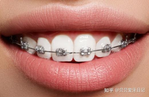 从牙套到保持器,如何把费用控制在1w内?手把手教你牙齿矫正省钱秘诀!