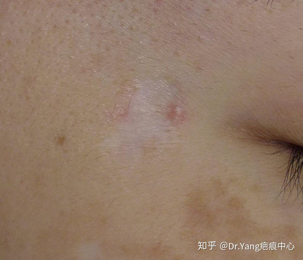 这样的色脱疤痕该如何处理