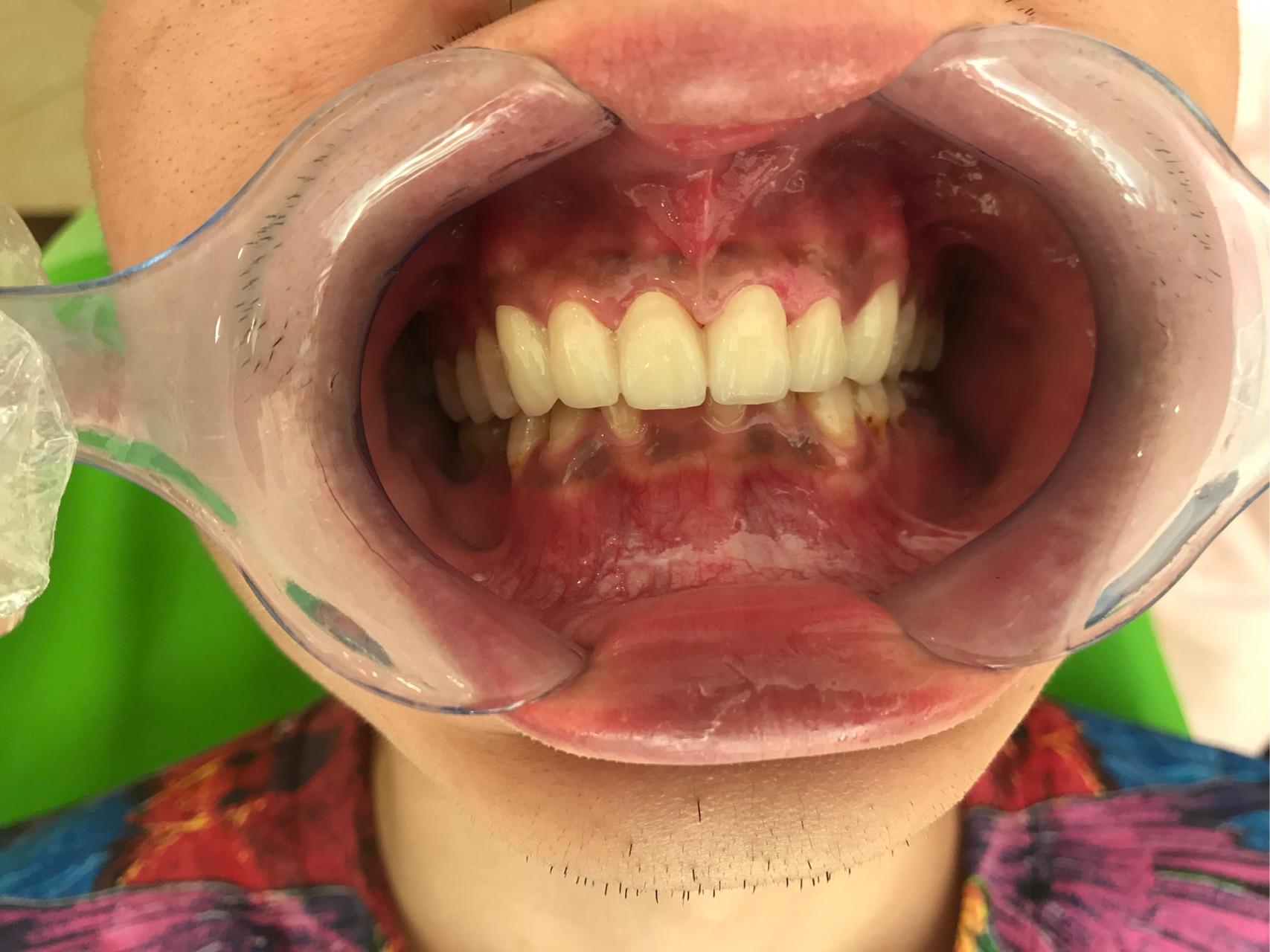 牙医碰见最烂的牙有多烂? - 知乎